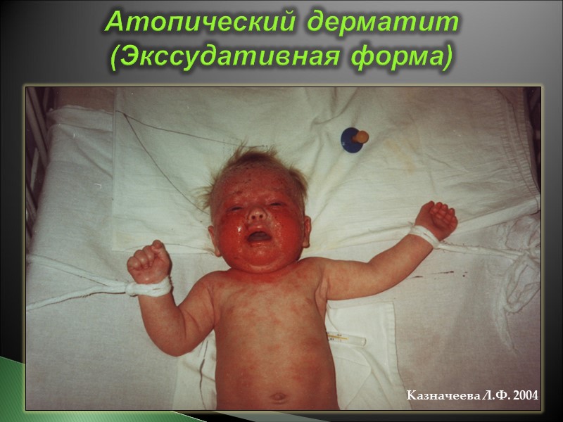 Казначеева Л.Ф. 2004 Атопический дерматит (Экссудативная форма)